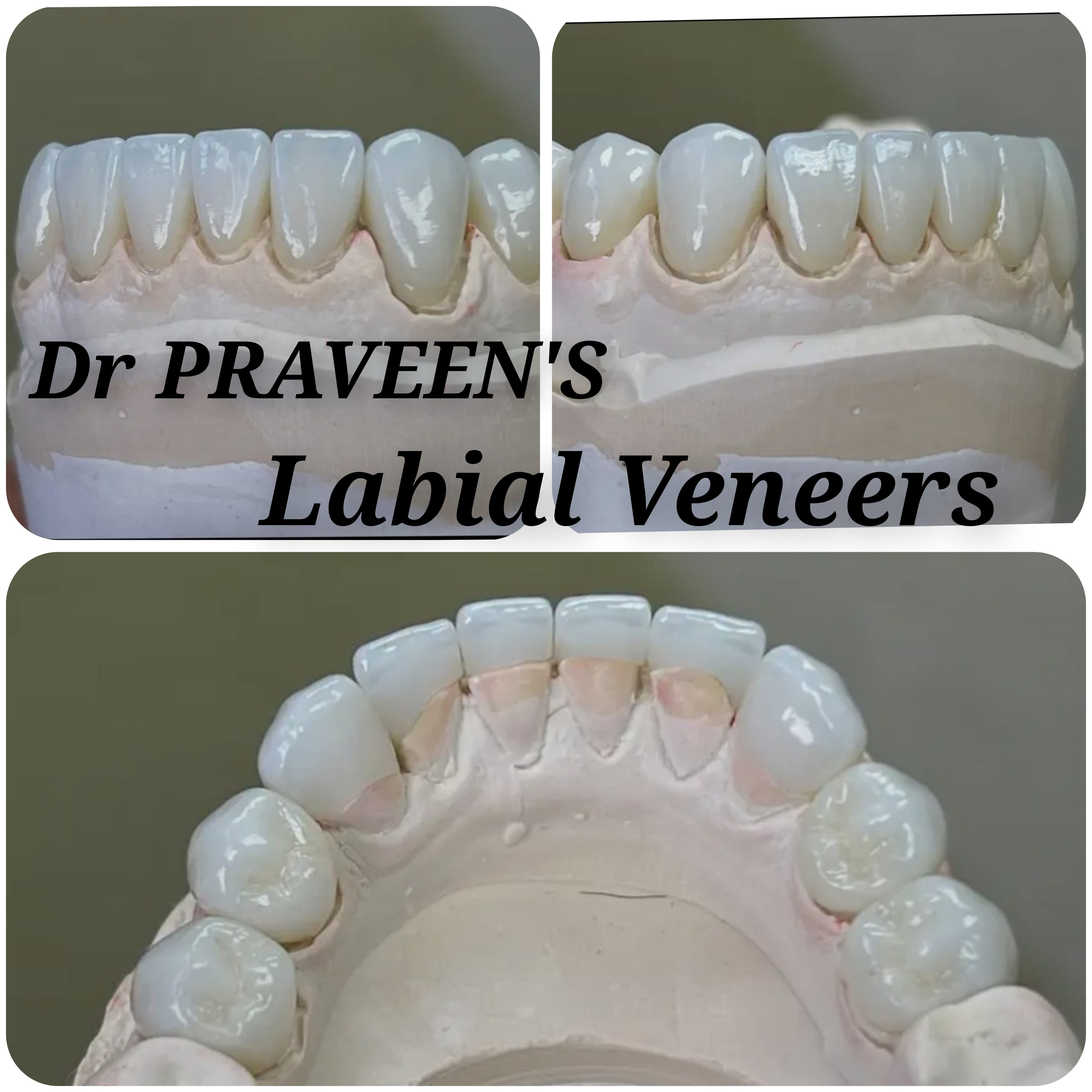 After Dentures