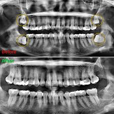After Extraction